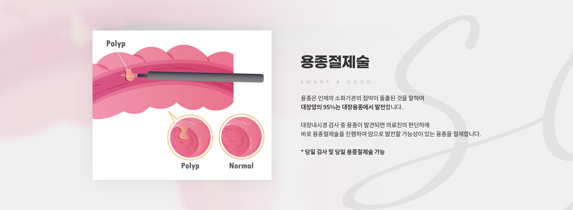대장내시경/용종절제술 용종절제술